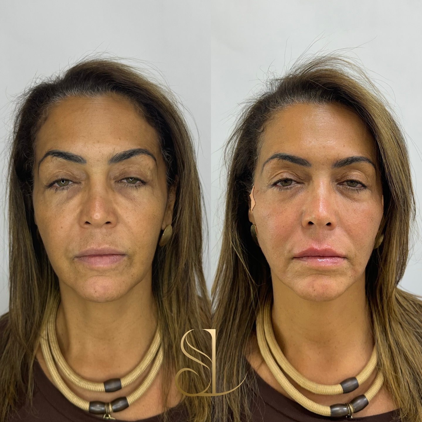 Resultado - antes e depois